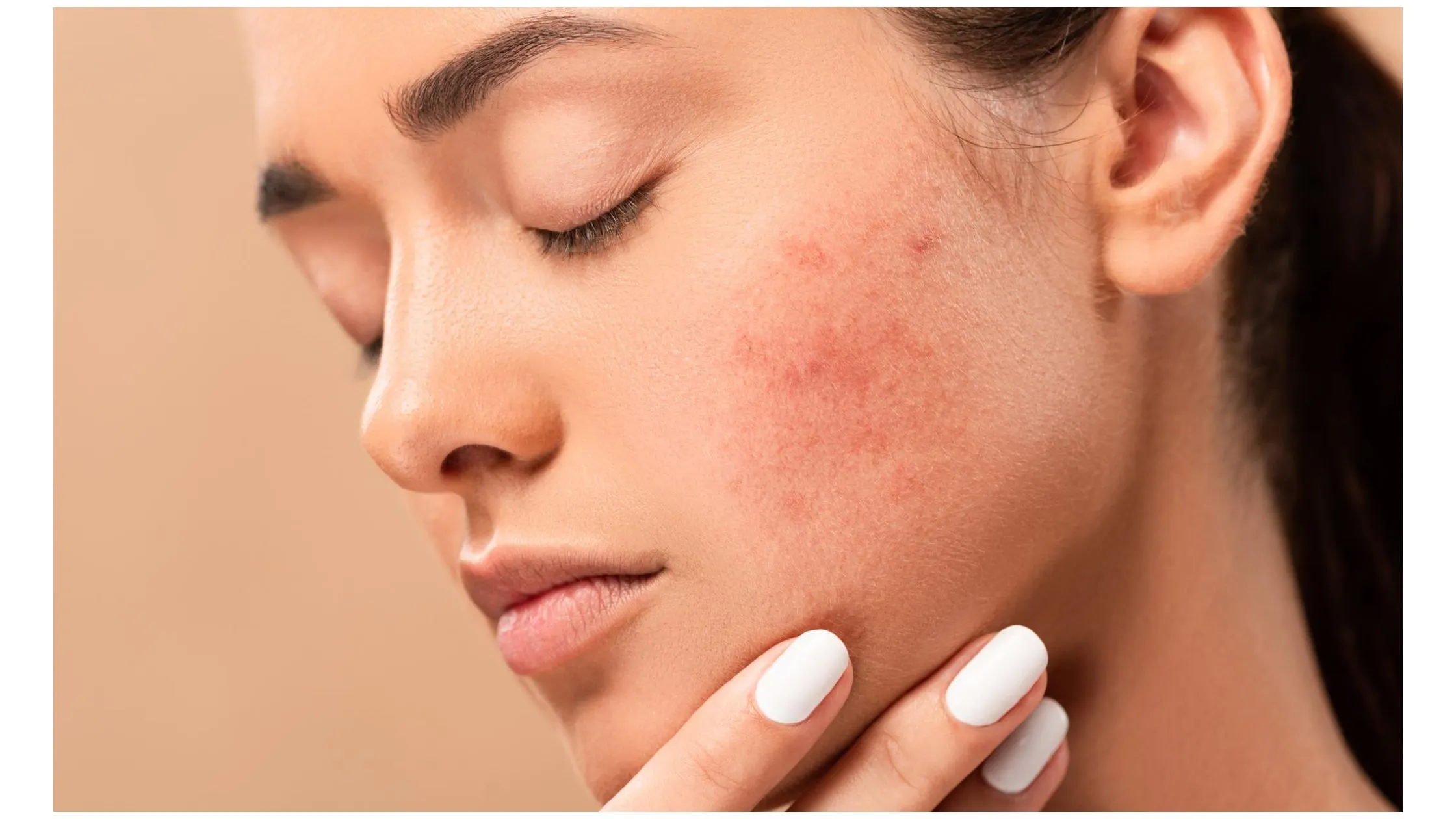 Home remedies to cure dark spots or black spots on the face